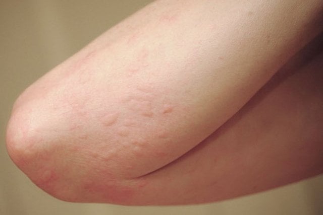 ban da là tác dụng phụ của thuốc Panactol