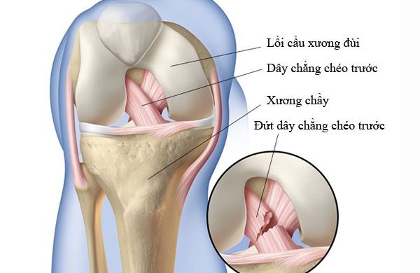 Hình ảnh mô tả tổn thương ở bộ phận này