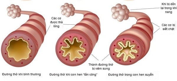 Minh họa sự co thắt của cơ trơn đường thở
