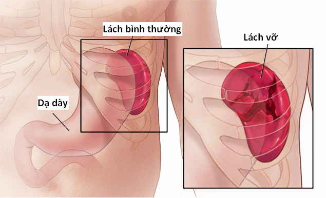 Hình ảnh lách vỡ.